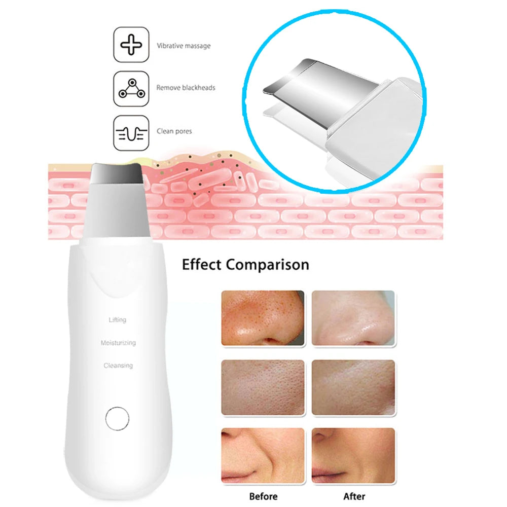 Limpiador Facial Ultrasónico — Remueve Impurezas